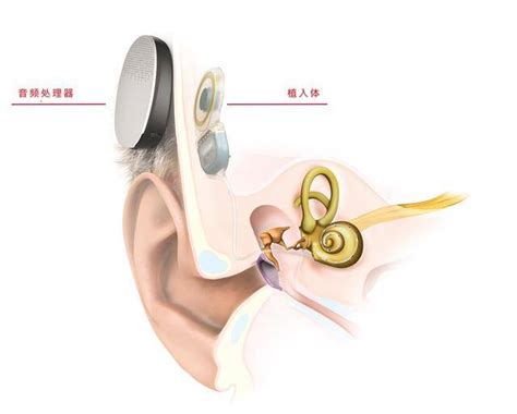 欧洲首例全植入人工耳蜗手术_听力