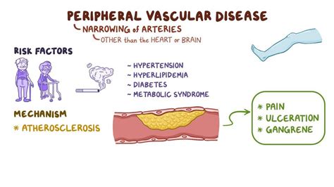 Peripheral vascular disease: Clinical practice - Osmosis