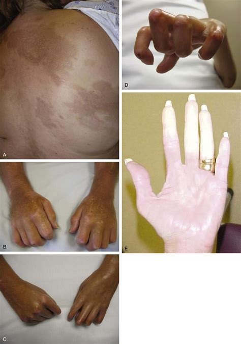 17+ best images about What is Scleroderma? on Pinterest | Spotlight ...