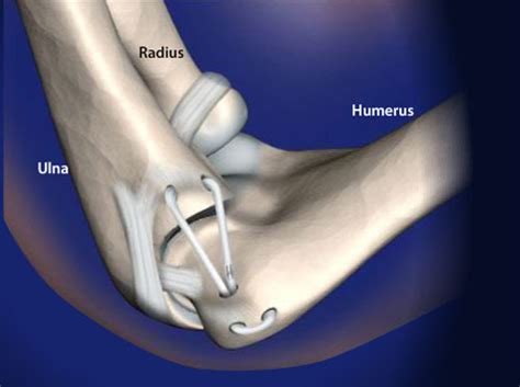 Video - Medial Ulnar Collateral Ligament Reconstruction (Tommy John Surgery) - HealthClips Online