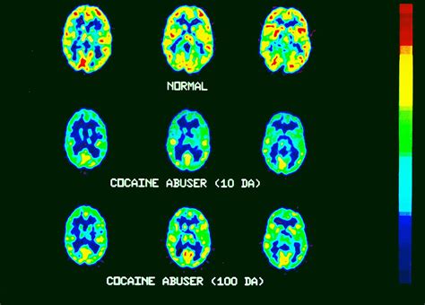 Brain Scan | A normal brain (top) and a cocaine abuser's 10 … | Flickr