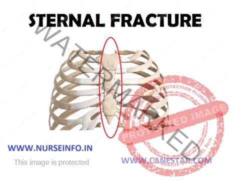 STERNAL FRACTURE - Nurse Info