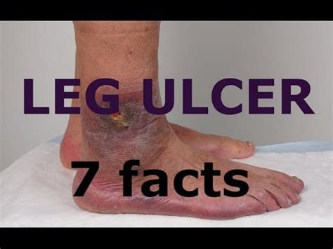 varicose ulcers - pictures, photos