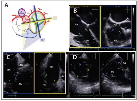 Cardiac Interventions Today - Echocardiography for Tricuspid Valve Intervention (July/August 2018)