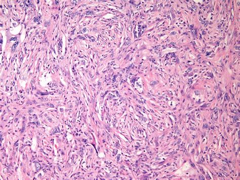 Malignant Fibrous Histiocytoma (MFH) of Bone