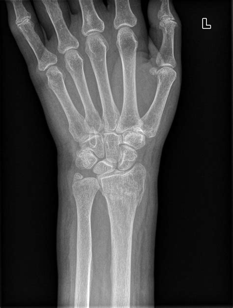 DISTAL RADIUS FRACTURES | buyxraysonline