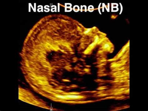 Nasal Bone Length Chart