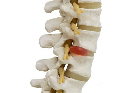 Herniated Disc: Overview and More