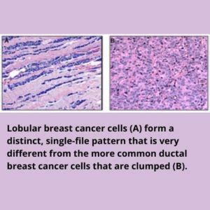 It's Not Just Breast Cancer, It's Lobular Breast Cancer - The Lobular ...