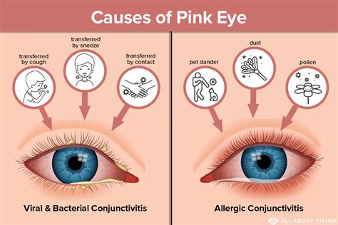Pink Eye (Conjunctivitis) Causes - All About Vision