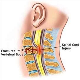 What is a spinal cord injury? | Answers | Spinal Cord Injury Zone!