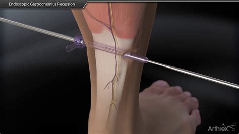 Endoscopic Gastrocnemius Recession - YouTube