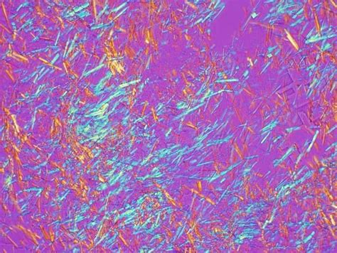 Monosodium urate crystals (Gout) under polarizing light microscopy : VaporwaveAesthetics