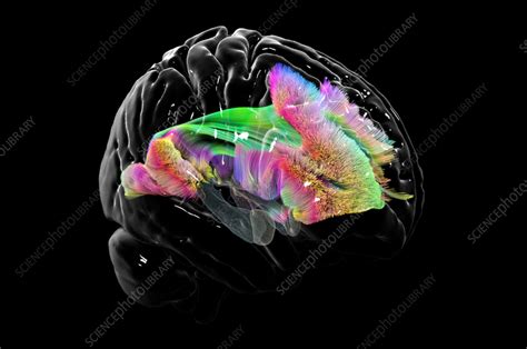 Arcuate fasciculus, DTI MRI scan - Stock Image - C058/1605 - Science ...