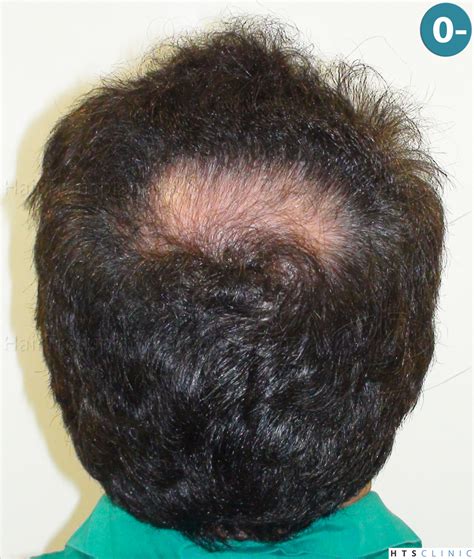 A very nice vertex work again | Hair loss Forum - Hair Transplant forums