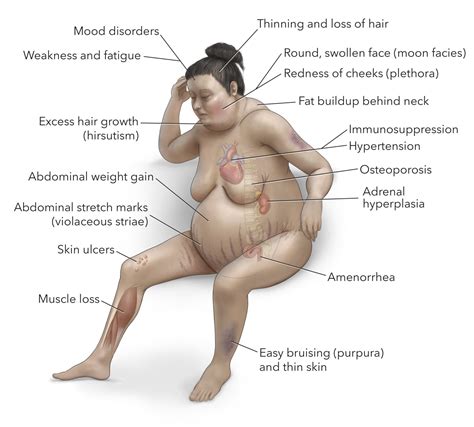 Unveiling Cushing's Syndrome: Understanding Its Causes and Effects ...