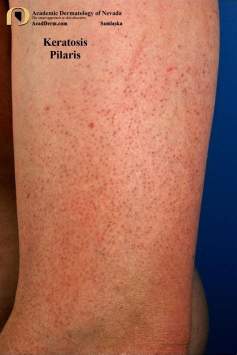 Keratosis Pilaris: It Feels Like Sandpaper... - Academic Dermatology of ...