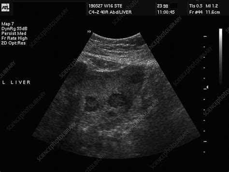 Liver cancer, ultrasound - Stock Image M134/0415 - Science Photo Library