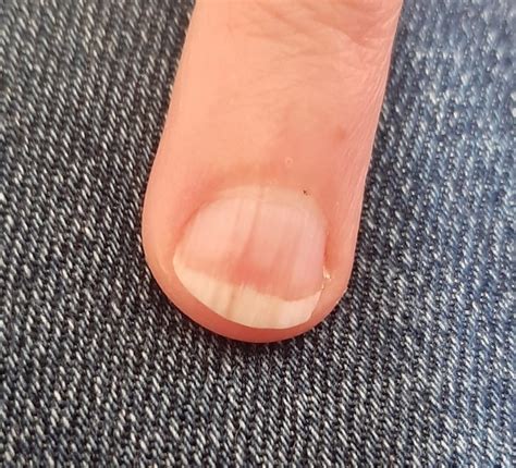 Vertical split all the way down my nail | Mumsnet