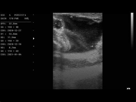 Cattle pregnancy diagnosis - Ultrasound slides - Bovine fetal growth - YouTube