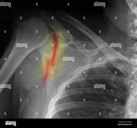 Shoulder x-ray showing fractured scapula Stock Photo - Alamy