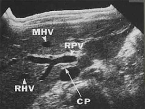 Liver/RUQ Anatomy