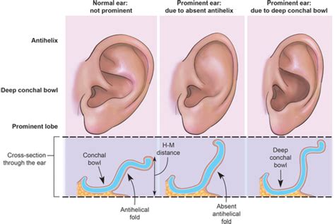 Earfold: A New Technique for Correction of the Shape of the Antihelix - Kang - 2018 - The ...