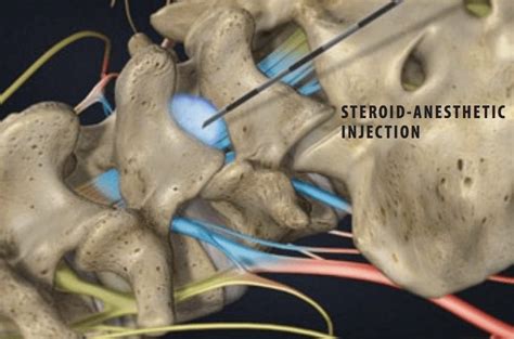 Side Effects Of Epidural Steroid Injections - Florida Surgery Consultants