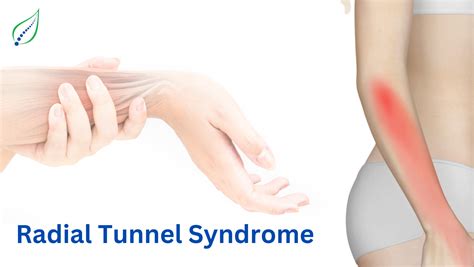 Radial Tunnel Syndrome: Symptoms, Causes, and Treatments | Best Back Pain, Slip Disc, Knee ...