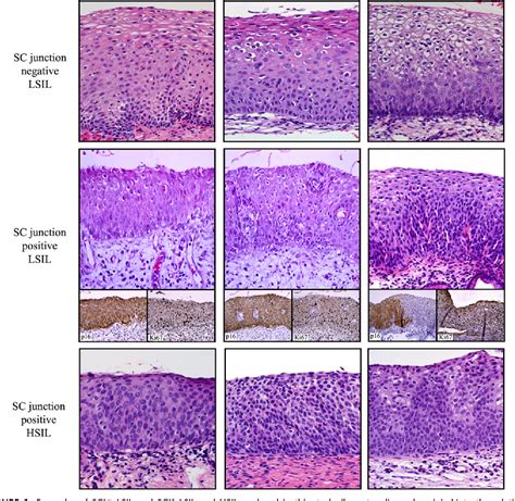 [PDF] Cervical squamocolumnar junction-specific markers define distinct, clinically relevant ...