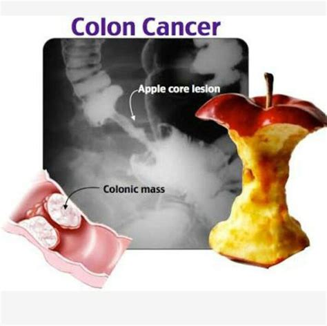 Colon cancer - apple core lesion - MEDizzy