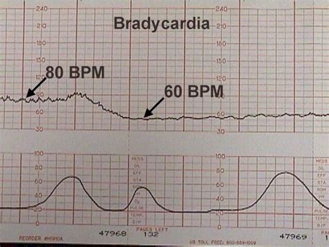 Electronic Fetal Heart Monitoring | Fetal heart monitoring, Fetal, Fetal monitoring