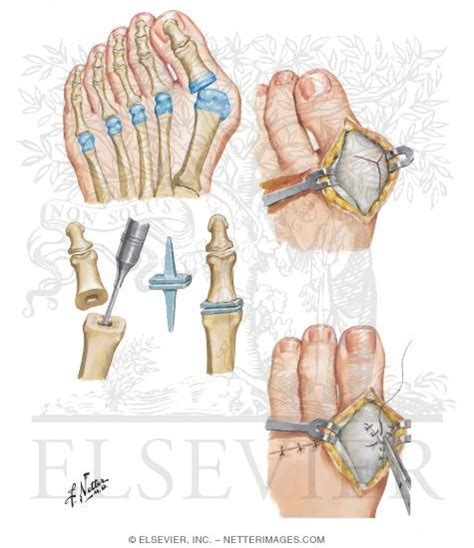 Silicone Implant Resection Arthroplasty for Rheumatoid Forefoot