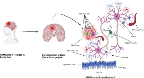 Formation of GBM tumors and their microenvironment. GBM tumors are ...