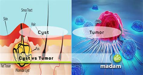 Difference Between Cyst and Tumor - biomadam