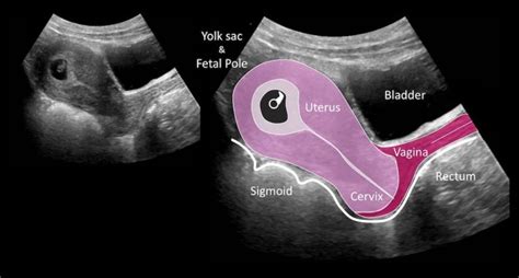 Ultrasound Case 046 • LITFL • POCUS Self-Assessment Quiz