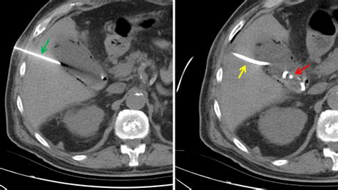 Percutaneous Cholecystostomy