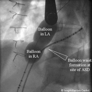 Release of Amplatzer ASO device. | Download Scientific Diagram