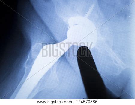 Hip Replacement Metal Image & Photo (Free Trial) | Bigstock