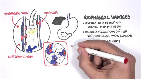 Gastrointestinal Bleeding