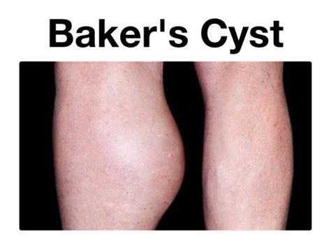 Ruptured Baker's Cyst - Emmett Technique Cairns Muscular Release Therapy, Australian made.