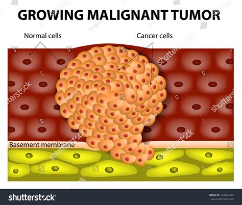 Cancer Cells Growing Malignant Tumor Malignant Stock Vector (Royalty ...