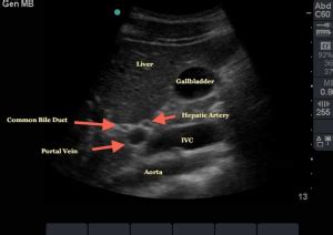 Biliary Ultrasound – Core EM