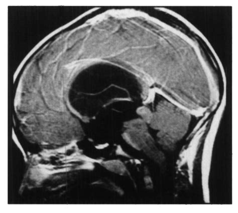 MRI example of a patient with a tectal glioma. This 9-yearold boy... | Download Scientific Diagram