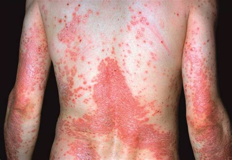 Developing new psoriasis treatment regimens for patients based on their ...