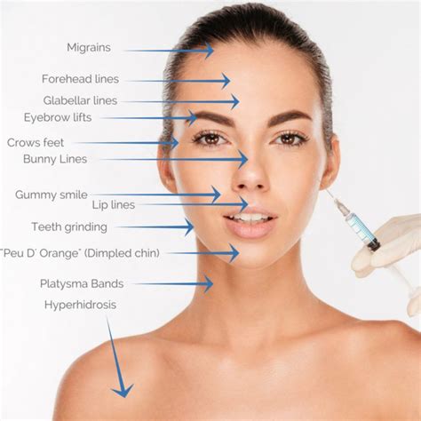 The Many Area’s that are Treatable with Botox in 2020 | How to line lips, Botox, Face care wrinkles