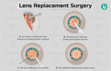 Lens replacement surgery: Procedure, Purpose, Results, Cost, Price