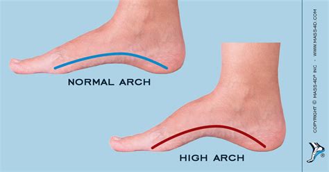 Orthotic Care for the Pes Cavus Foot - MASS4D® Foot Orthotics