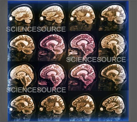 Alzheimer's disease, MRI brain scans | Stock Image - Science Source Images