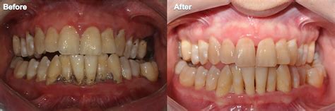 Dental Images Before and After in Indianapolis, IN | Sonrisa Dental